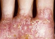Дисгидротическая эпидермофития