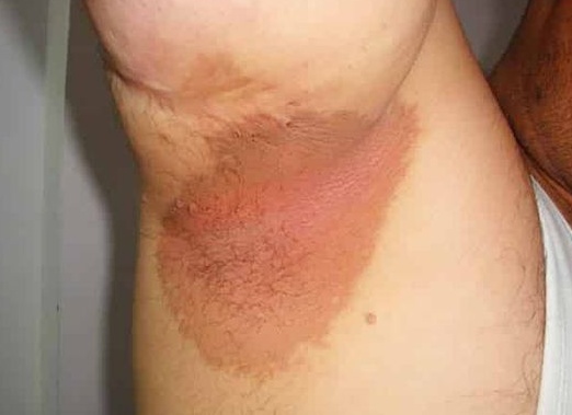 Лечение эритразмы