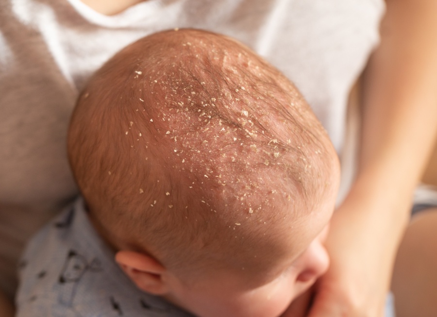 Себорея у детей