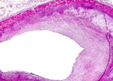 Как можно почистить сосуды на самом деле