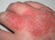 Острая экзема