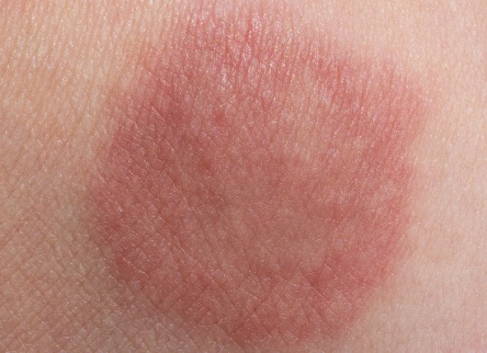 Эритразма у взрослых