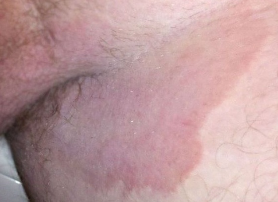 Паховая эпидермофития