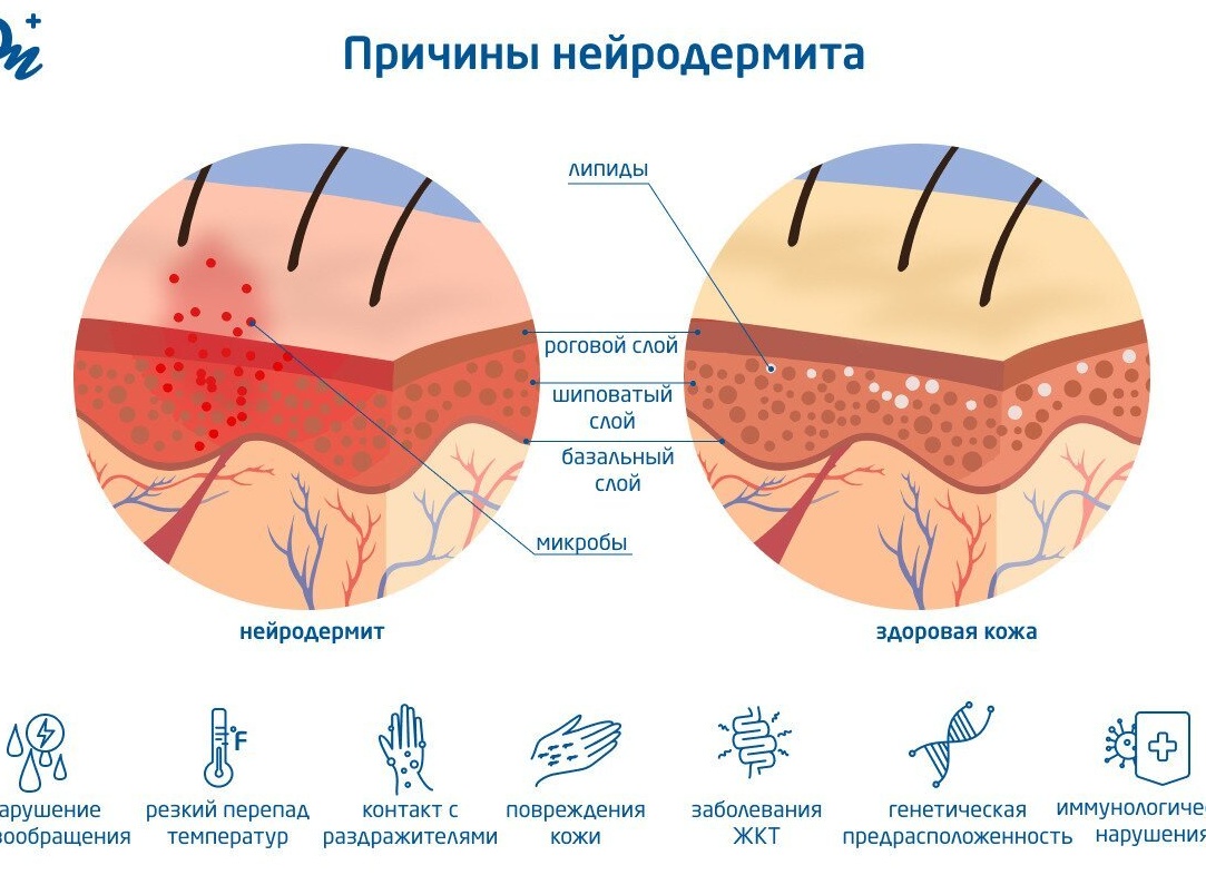 Причины нейродермита