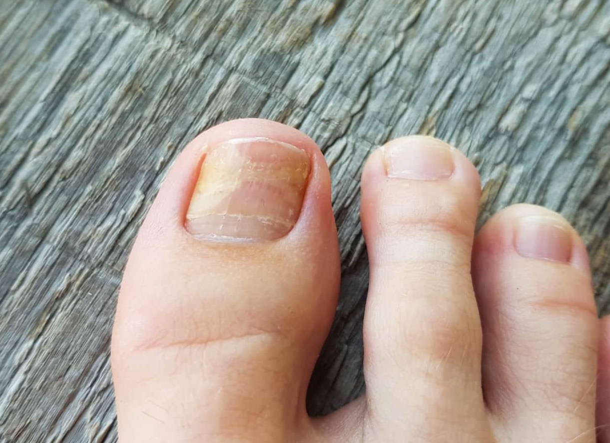 Микоз ногтей