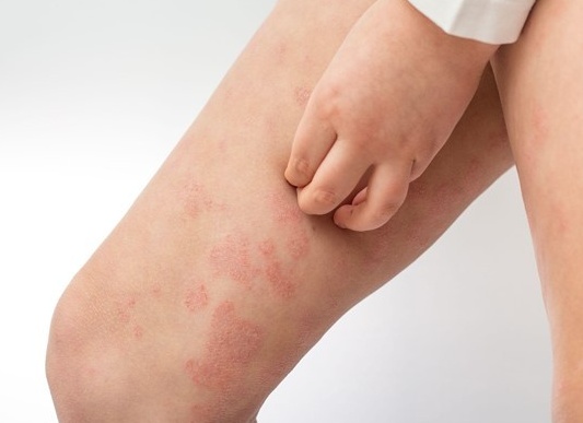 Кожный зуд у детей