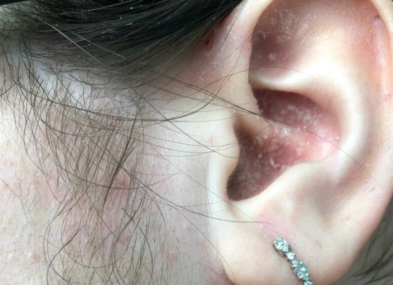 Себорея после стресса