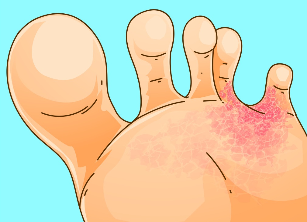 Диагностика эритразмы Диагностика эритразмы