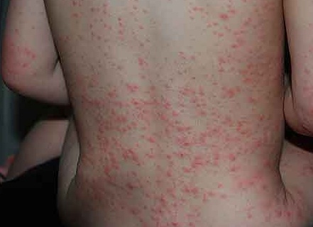 Симптомами каких недугов является кожная сыпь