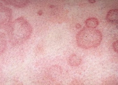 Почему чешется голова и как избавиться от зуда