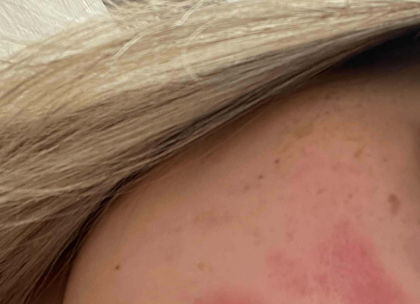 Имеются ли у экземы последствия?