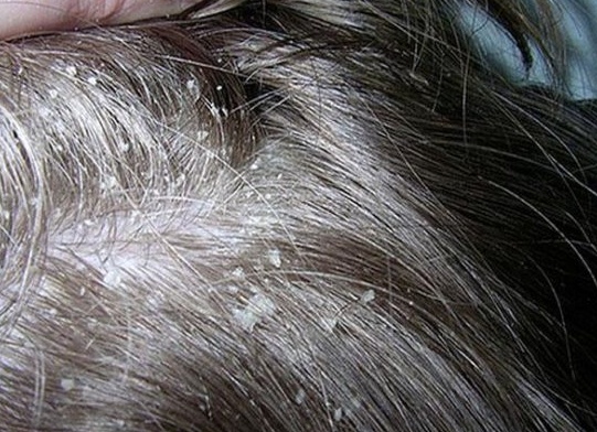 У сына ужасная перхоть на голове